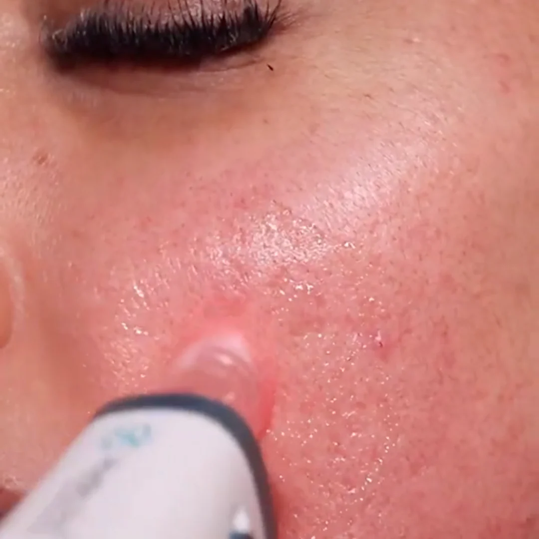 *NEW* Dr. Pen H6 Advanced Serum Infusion Microneedling Pen with Light Therapy - Image 4